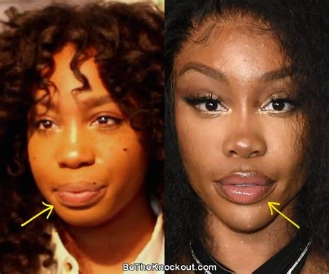 did sza get plastic surgery did she have any facial surgeries?